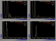 A-Mode-Sonographie der Nasennebenhöhlen