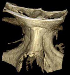 DVT 3D Nasenbeinfraktur