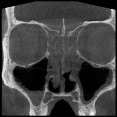 DVT der NNH: Polyposis