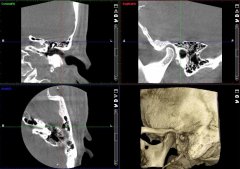 DVT des Mittelohres links in 3 Ebenen sowie 3D