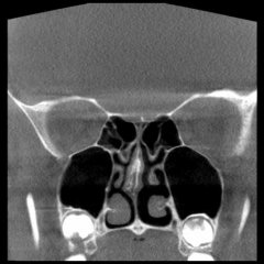 DVT der NNH mit retinierten Weisheitszähnen in beiden Kieferhöhlen