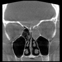 DVT der NNH mit isoliert verschatteter linker Siebbeinhöhle