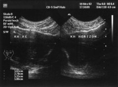 B-Mode-Sonographie der Nasennebenhöhlen