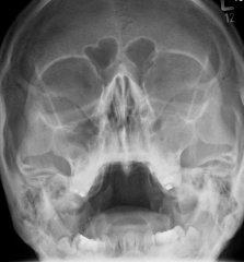 2D-Röntgen der Nasennebenhöhlen o.m.