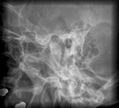 2D-Röntgen des Ohrknochens nach Schüller